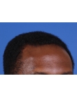 After Hair Transplant&nbsp;Front